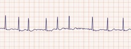 EKG strip of A Fib