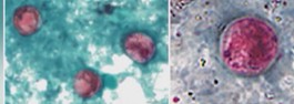 cycloriasis