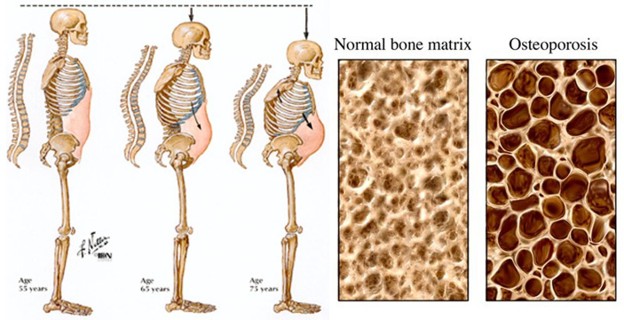 osteoporosis