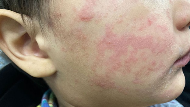Typical skin rash at 10-15 days after infection
